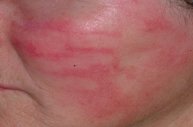 Redness clears with intense pulsed light